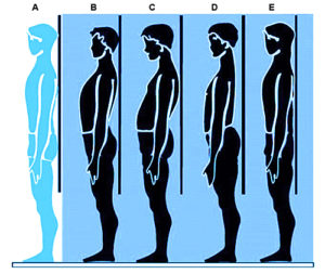 A. Soggetto normale B. Piano allineato, aumento delle curve C. Piano scapolare posteriore D. Dorso piatto, piano scapolare anteriore E. Piano allineato, diminuzione delle curve